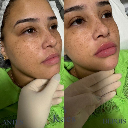 Preenchimento Labial (2)