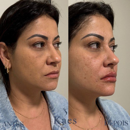 Preenchimento Labial (3)