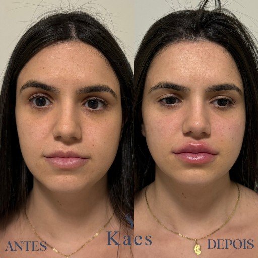 Preenchimento Labial (4)