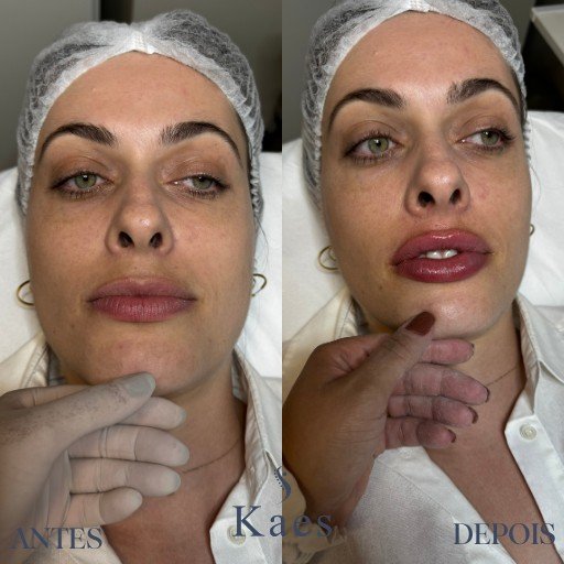 Preenchimento Labial